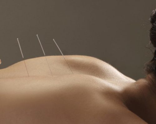 acupuncture-chinoise